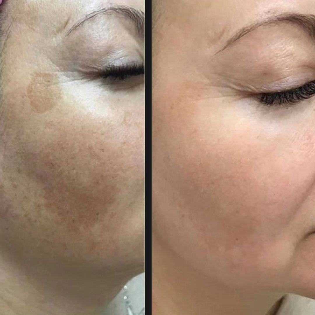 MELINE-SPOTS SUN SPOTS TREATMENT IN LONDON UK