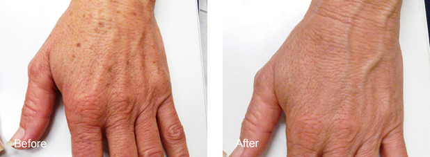 SUN-SPOTS-TREATMENT-ME-LINE Sun-Spots-Treatment-Me-Line