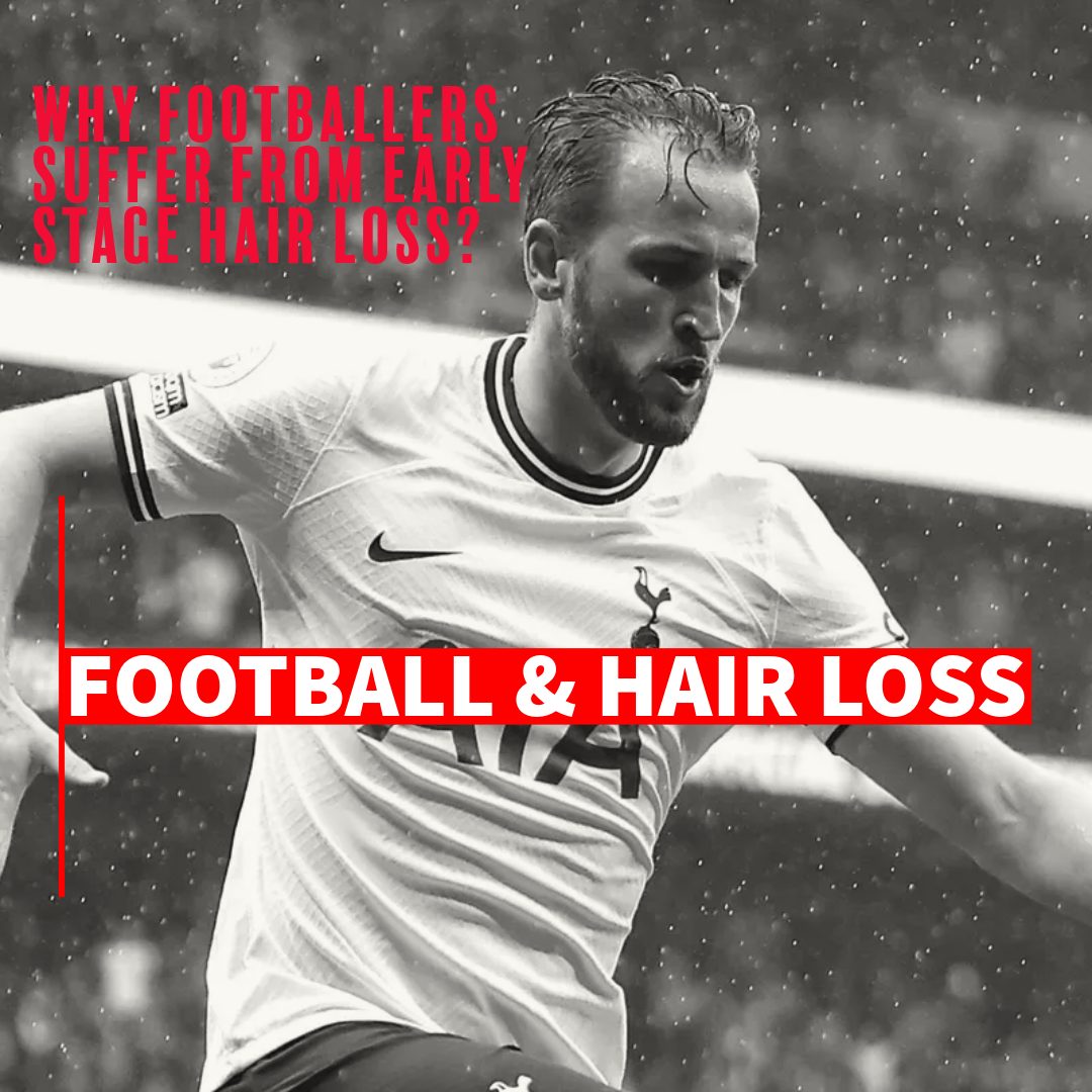 Footballers hair loss