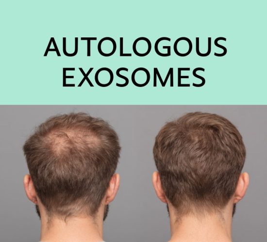 AUTOLOGOUS EXOSOMES HAIR RESTORATION LONDON