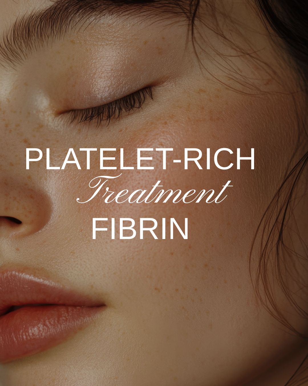 PRF-FACE-Treatment prf-face-treatment