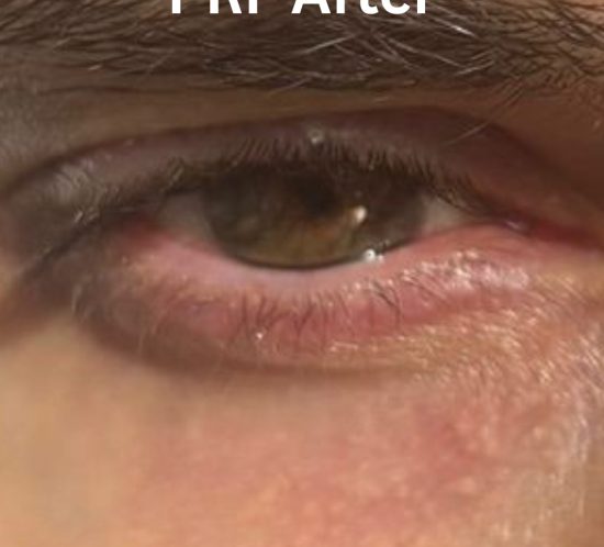 PRF under-eyes After picture