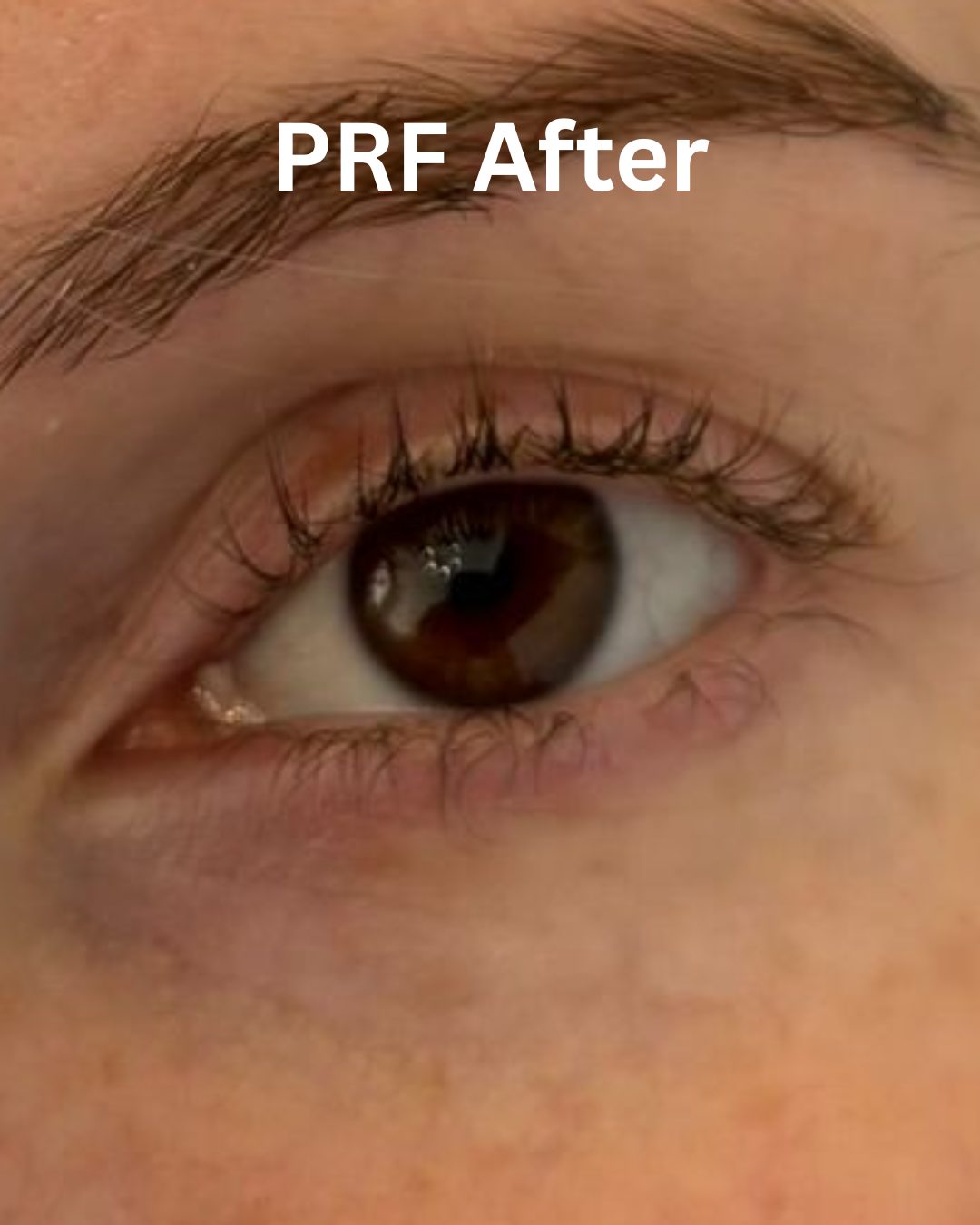 After Platelet-Rich Fibrin Under-eyes