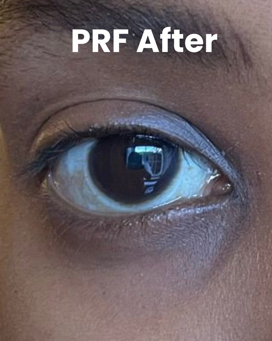 After PRF under-eyes pic