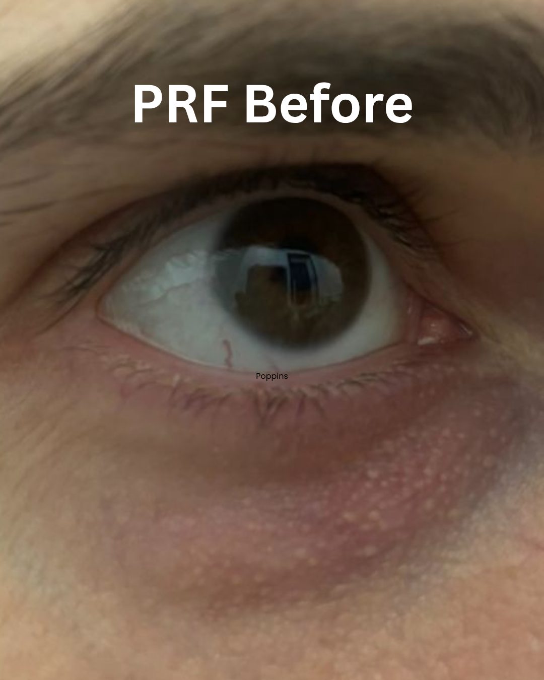 PRF under-eyes Before picture