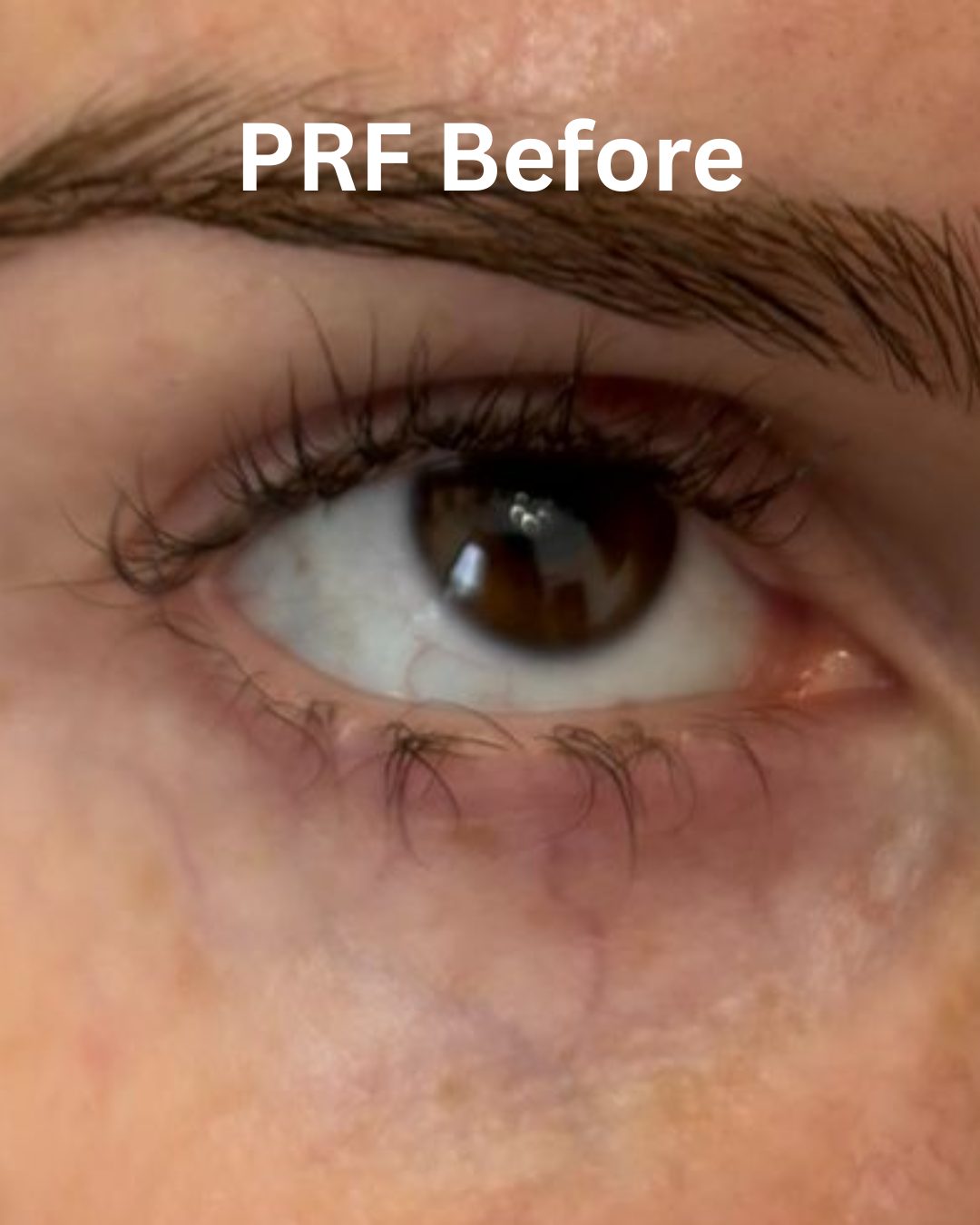 Before Platelet-Rich Fibrin Under-eyes