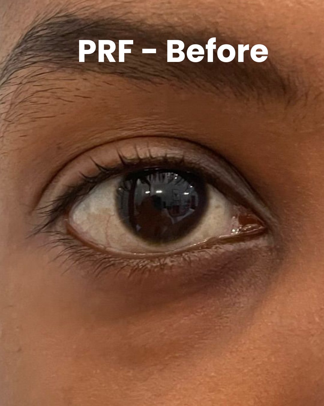 Before PRF under-eyes